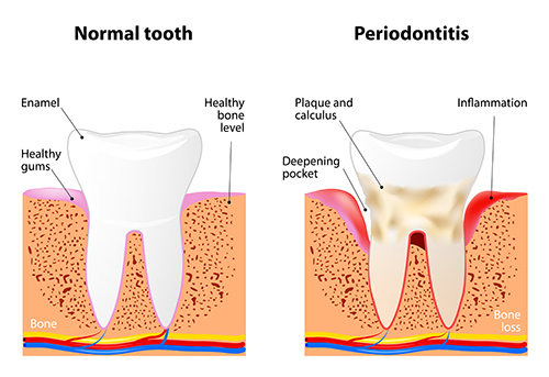 Periodontal Disease Treatment | Periodontal Health and Disease