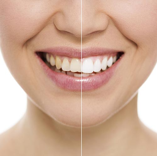 Teeth Whitening Near Me | Zoom Teeth Whitening Houston TX - Edge Dental