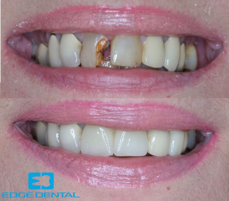 Dental Crowns Near Me Porcelain Crowns Houston TX Edge Dental