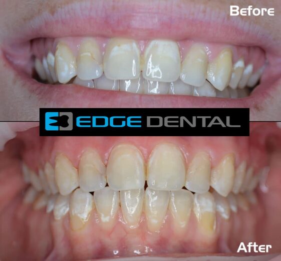 What is Cosmetic Bonding? Learn More About Cost of Cosmetic Bonding