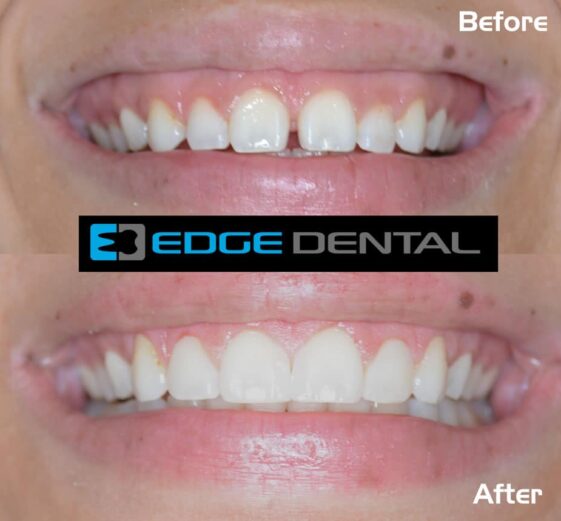 What is Cosmetic Bonding? Learn More About Cost of Cosmetic Bonding