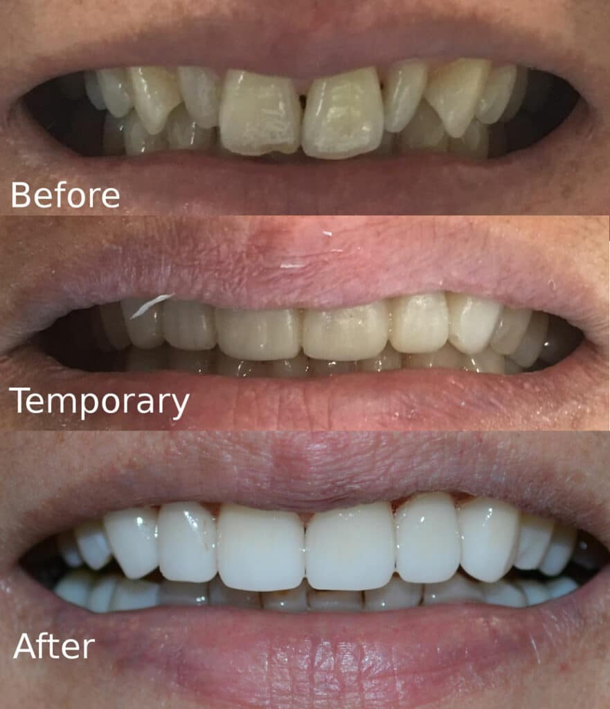 Temporary Veneers