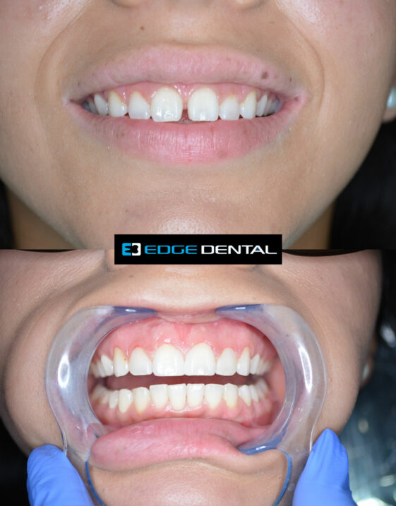 Before and After Edge Dental Houston