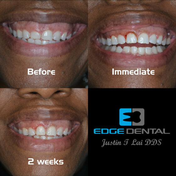 Before and After Edge Dental Houston